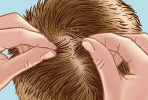 LIce