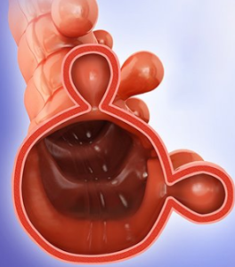 Diverticulitis management